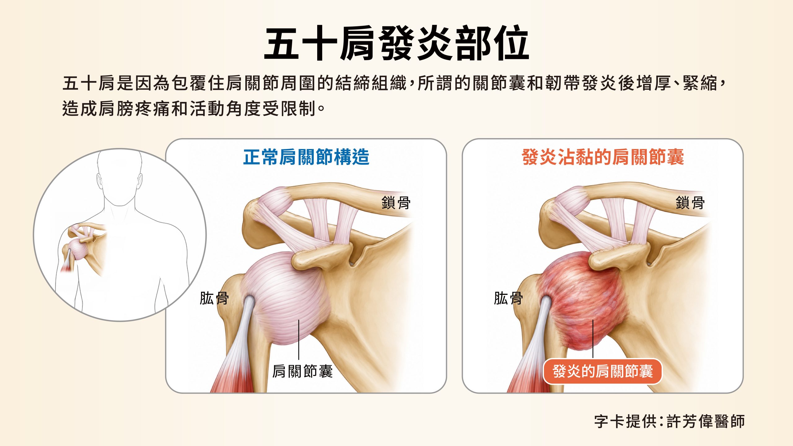 五十肩位置