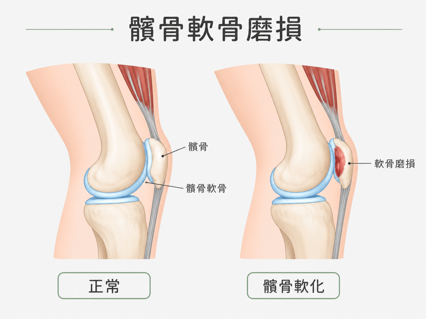 髕骨軟骨膜損