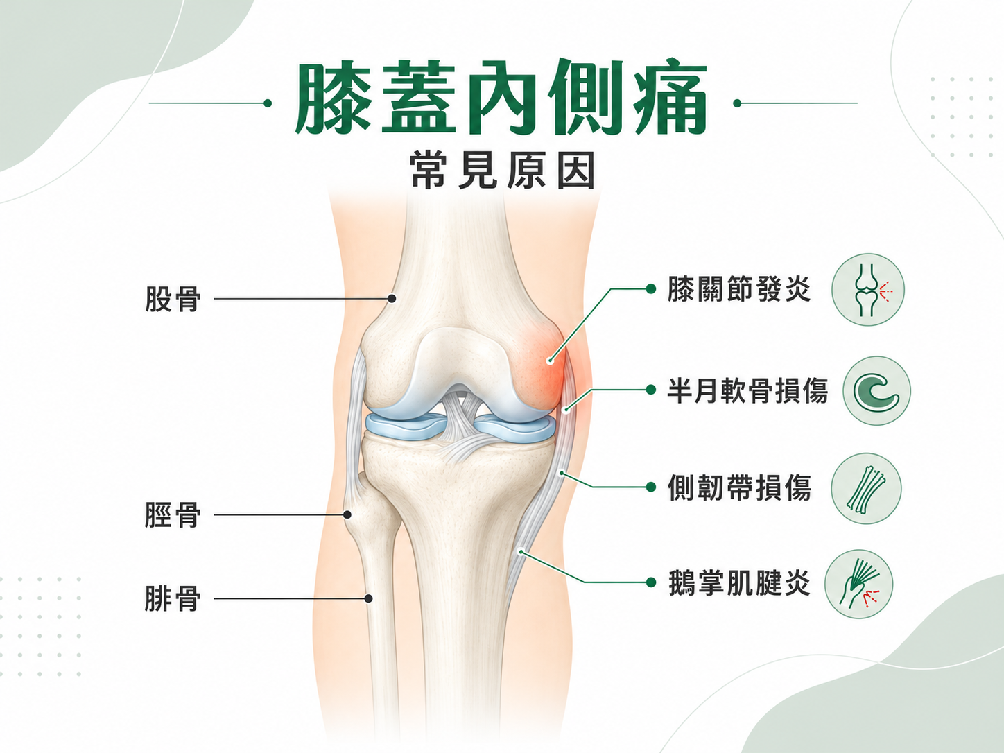 膝蓋內側痛原因與復健運動