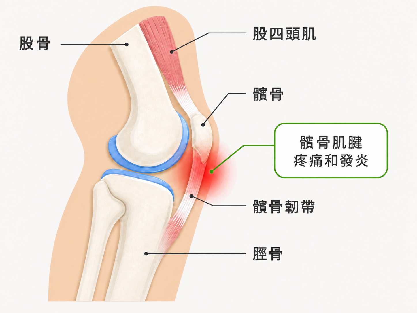 跳躍膝（髕骨韌帶炎）