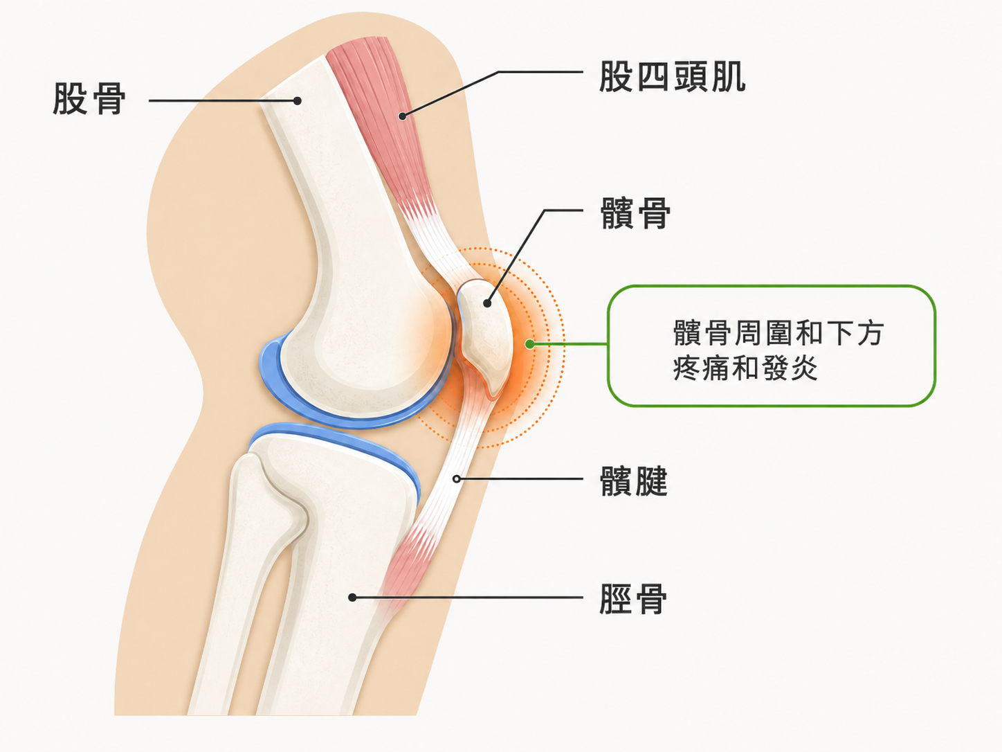 跑者膝（髕骨疼痛症候群）位置