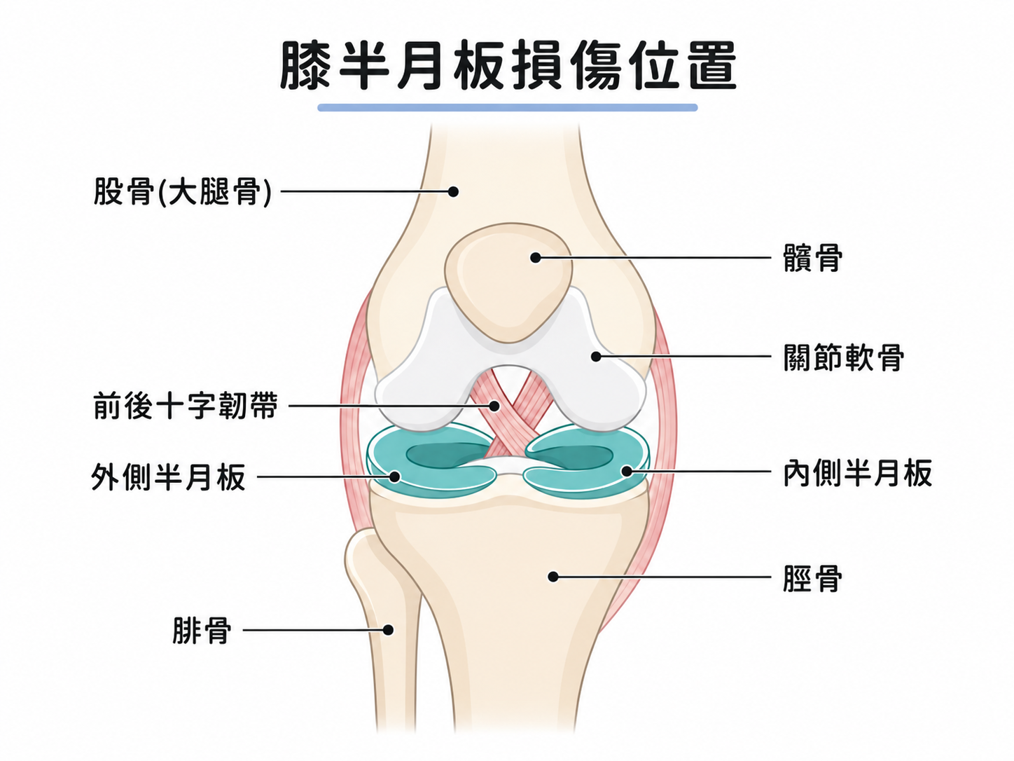 膝半月板軟骨損傷位置與復健運動