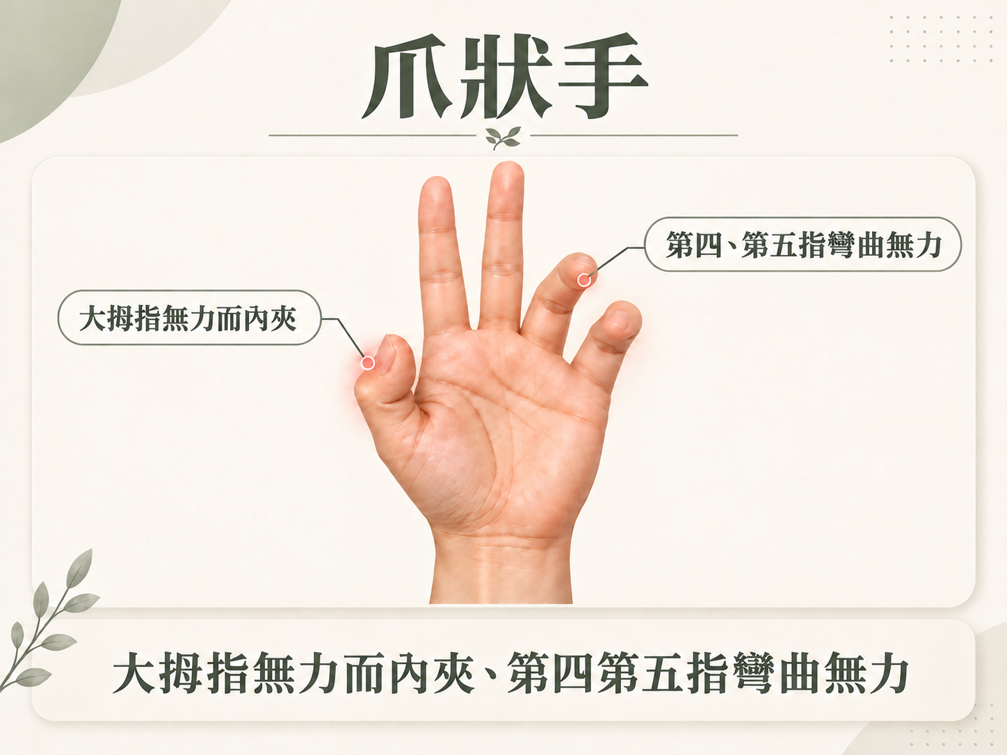 尺神經壓迫造成的爪狀手(Claw Hand)