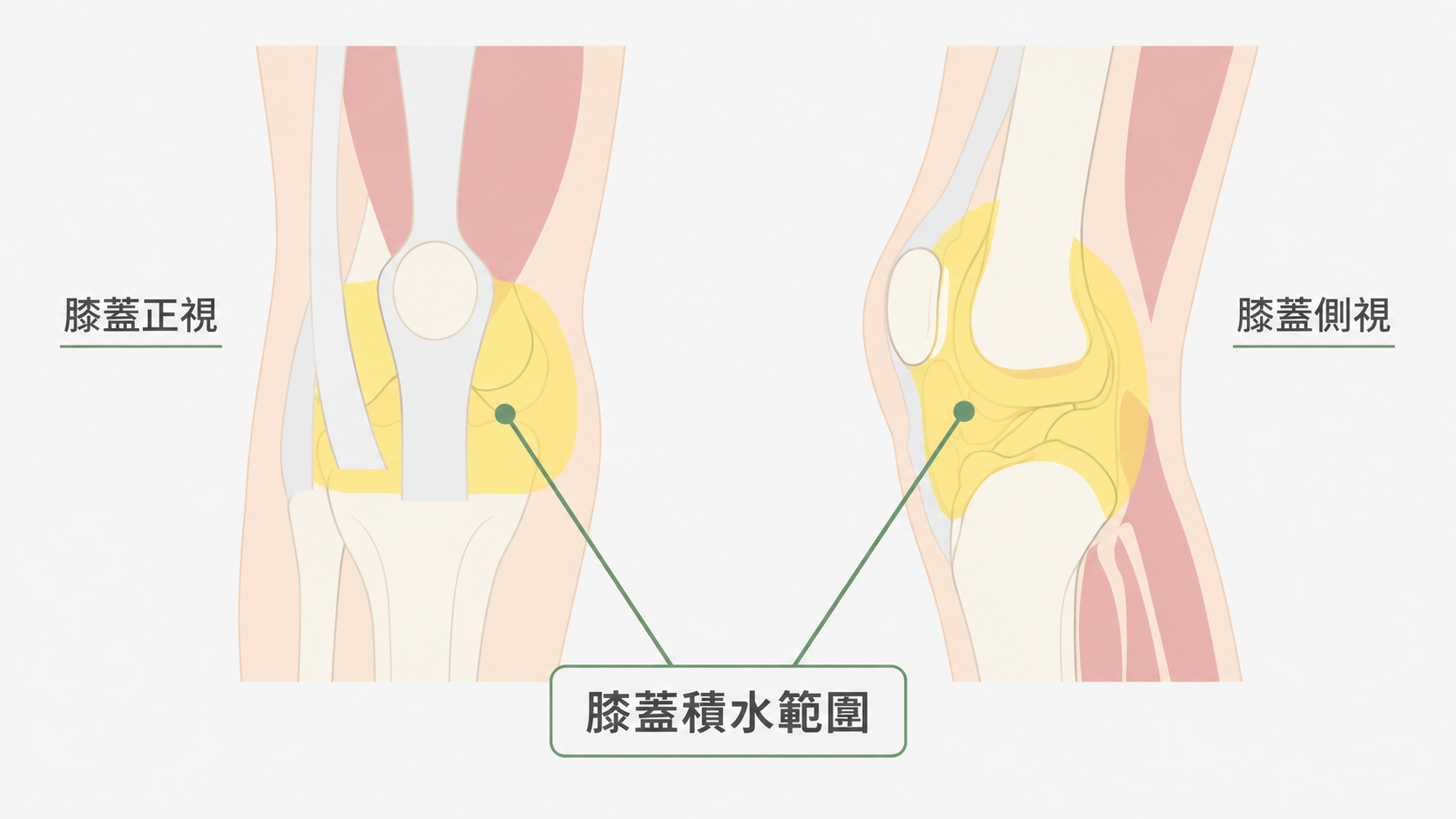 膝蓋積水