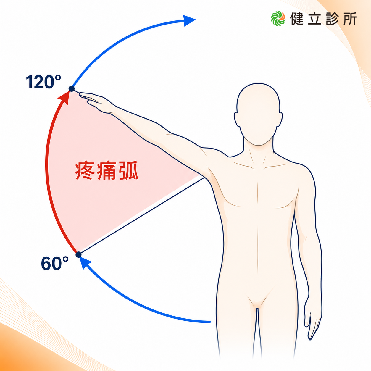 間夾擠症候群症狀-疼痛弧示意圖