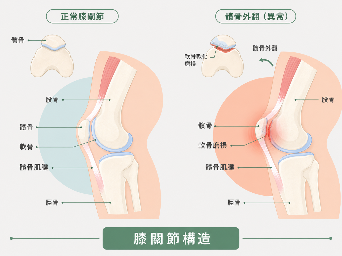髕骨股骨疼痛症候群